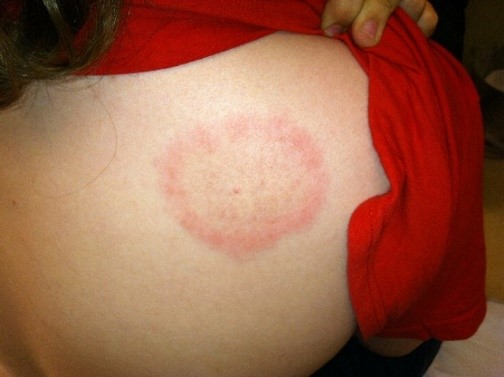 tick bite rash tick bite rash